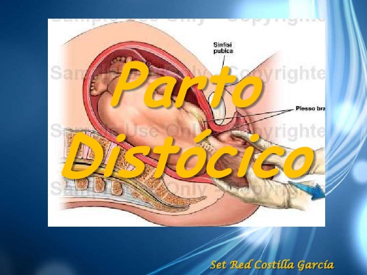 Parto Distocico Pdf